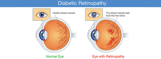 Diabetic Retinopathy 